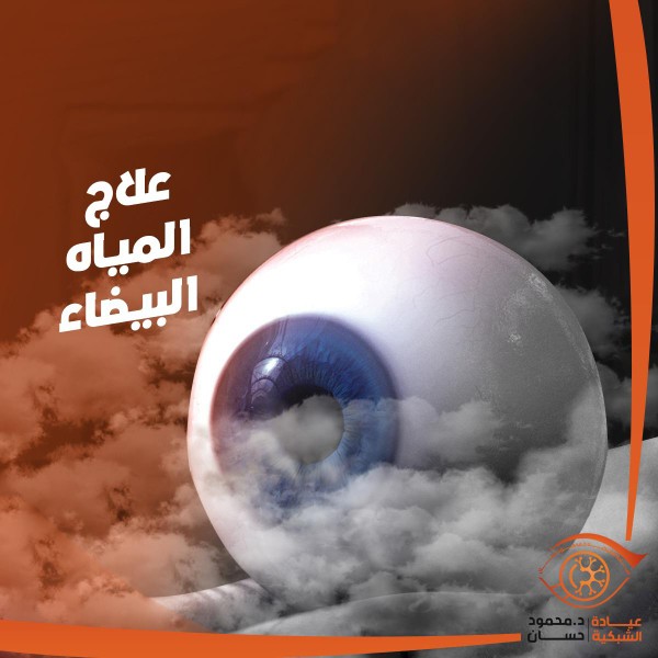 تكلفة عملية المياه البيضاء في العين