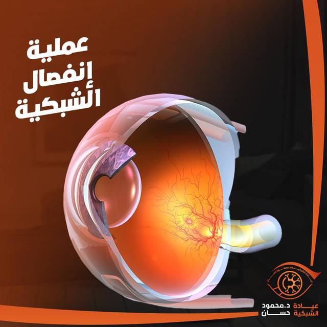 د. محمود حسان استشاري الشبكية و المياه البيضاء